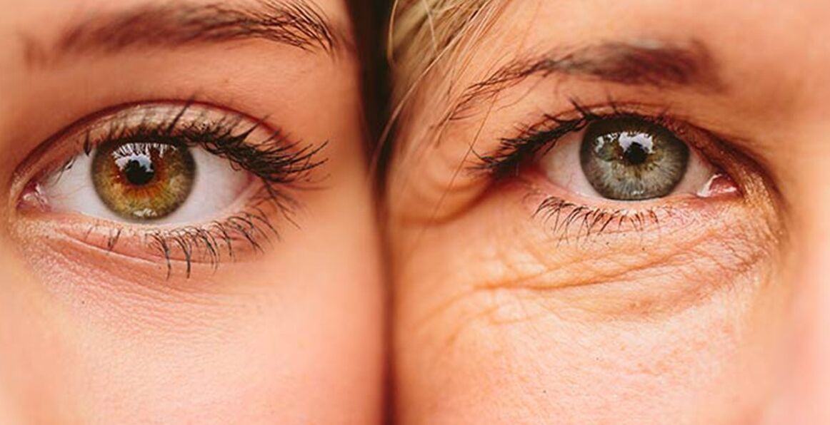 Tanda-tanda luaran penuaan kulit di sekeliling mata pada dua wanita yang berbeza umur