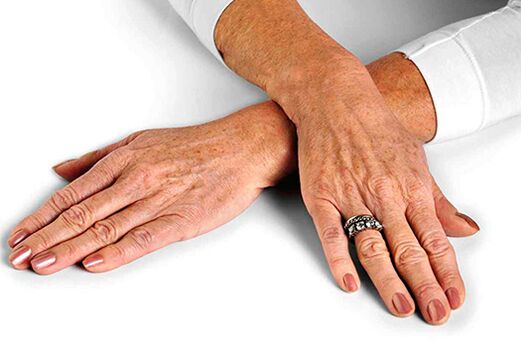 Kulit tangan dengan perubahan berkaitan usia yang memerlukan penggunaan teknik peremajaan