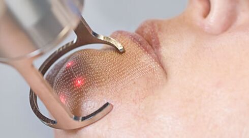 Kursus prosedur untuk peremajaan kulit wajah laser pecahan