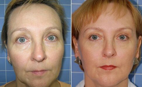 Sebelum dan selepas peremajaan wajah laser pecahan