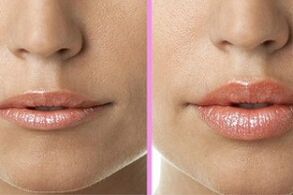 sebelum dan selepas pemulihan bibir